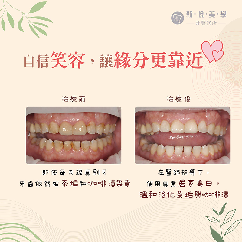 微笑，從齒開始牙齒美白讓你自信綻放魅力的第2張圖片
